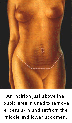 tummy tuck