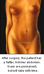 tummy tuck pictures