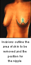 breast reductions