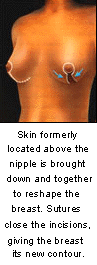 breast reduction surgery